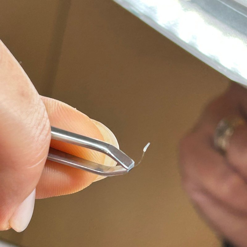 avant après thermolyse épilise résultat réel