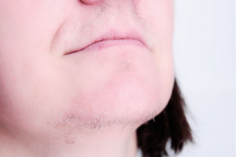 avant thermolyse hirsutisme menton profil