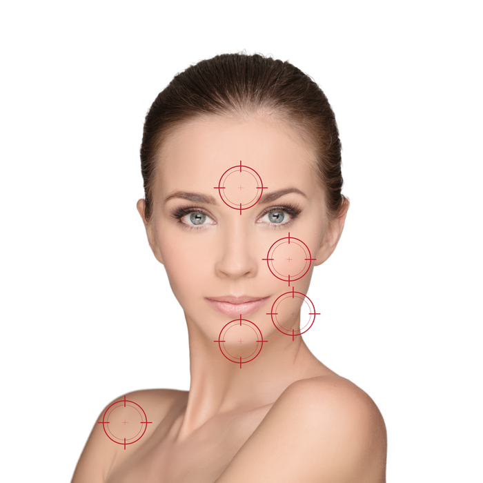 zones de traitement thermolyse visage zones hormonales